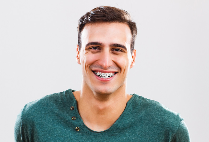 A Deeper Look at Metalic Braces vs Clear Aligners