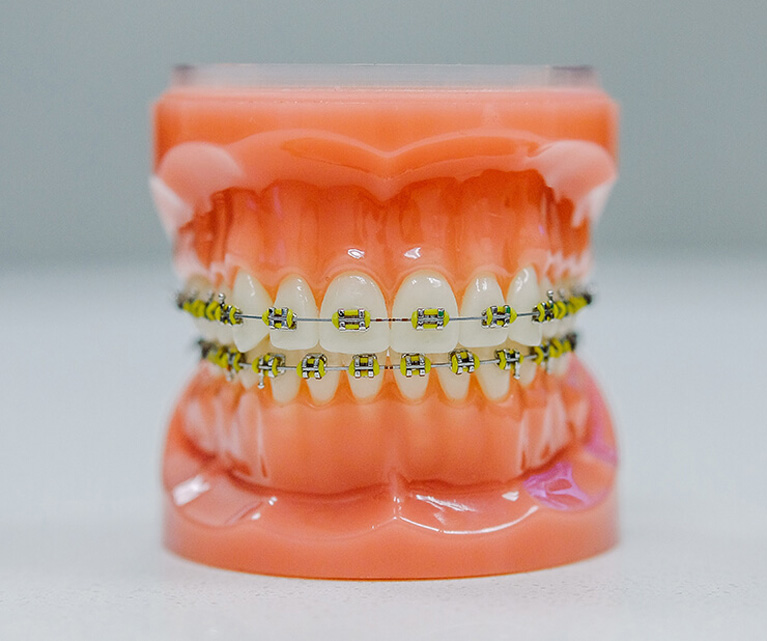 What are fixed braces?