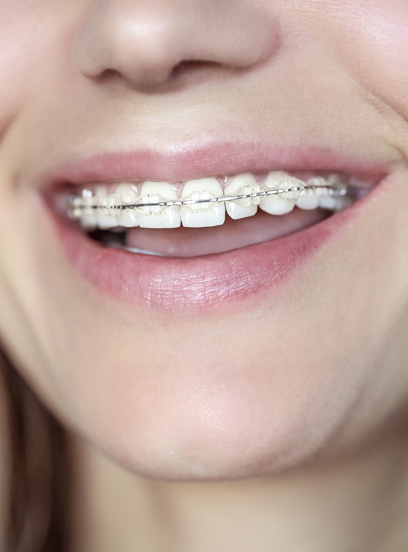 Traditional metal and ceramic braces